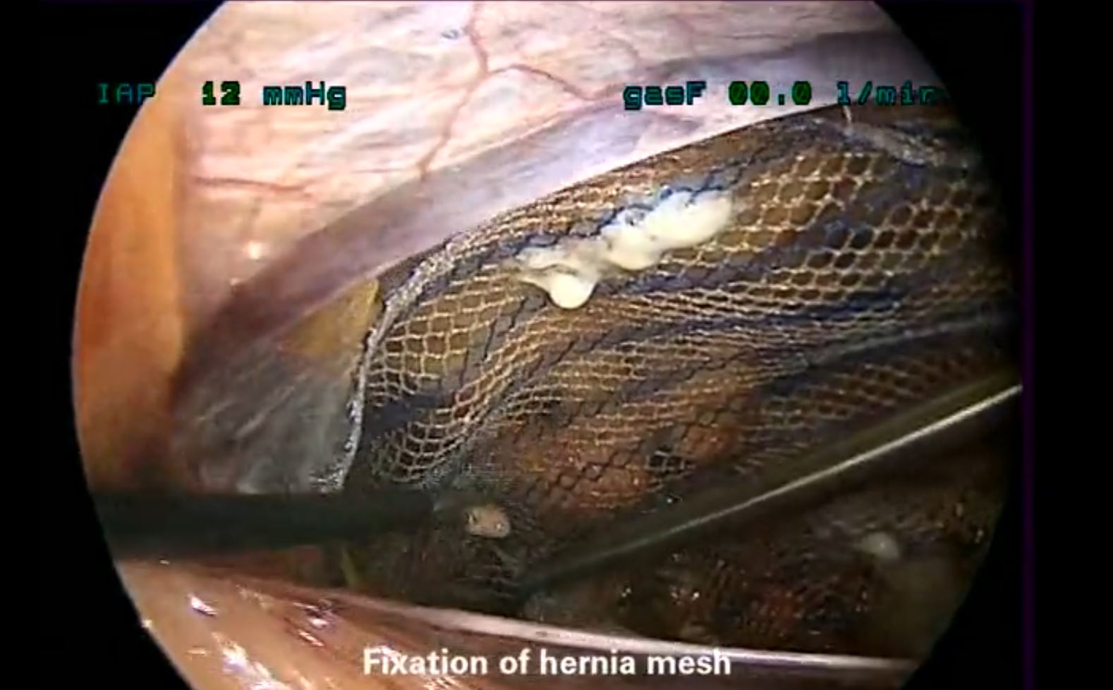 Laparoscopic hernia repair Vivostat