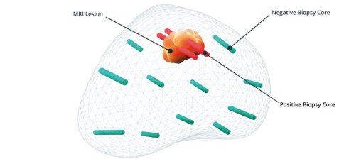 Prostate core web