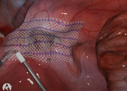 Liquiband Fix8 Duomed Hernia Solutions