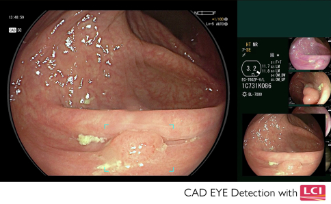 Detection