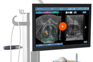 Fusion Guided Prostate Biopsy