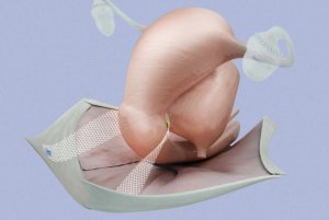 BSC Mesh