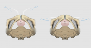 Incontinence