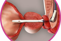 Prostatic stent