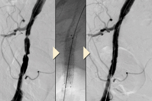 Arterial stents