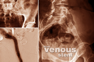 Venous stents