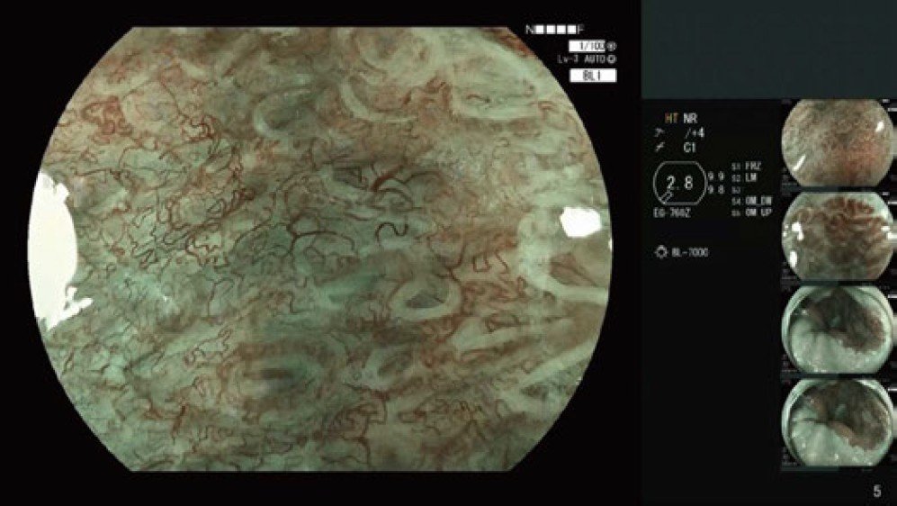 EG-760 Z Optical Magnification Gastroscope | Duomed