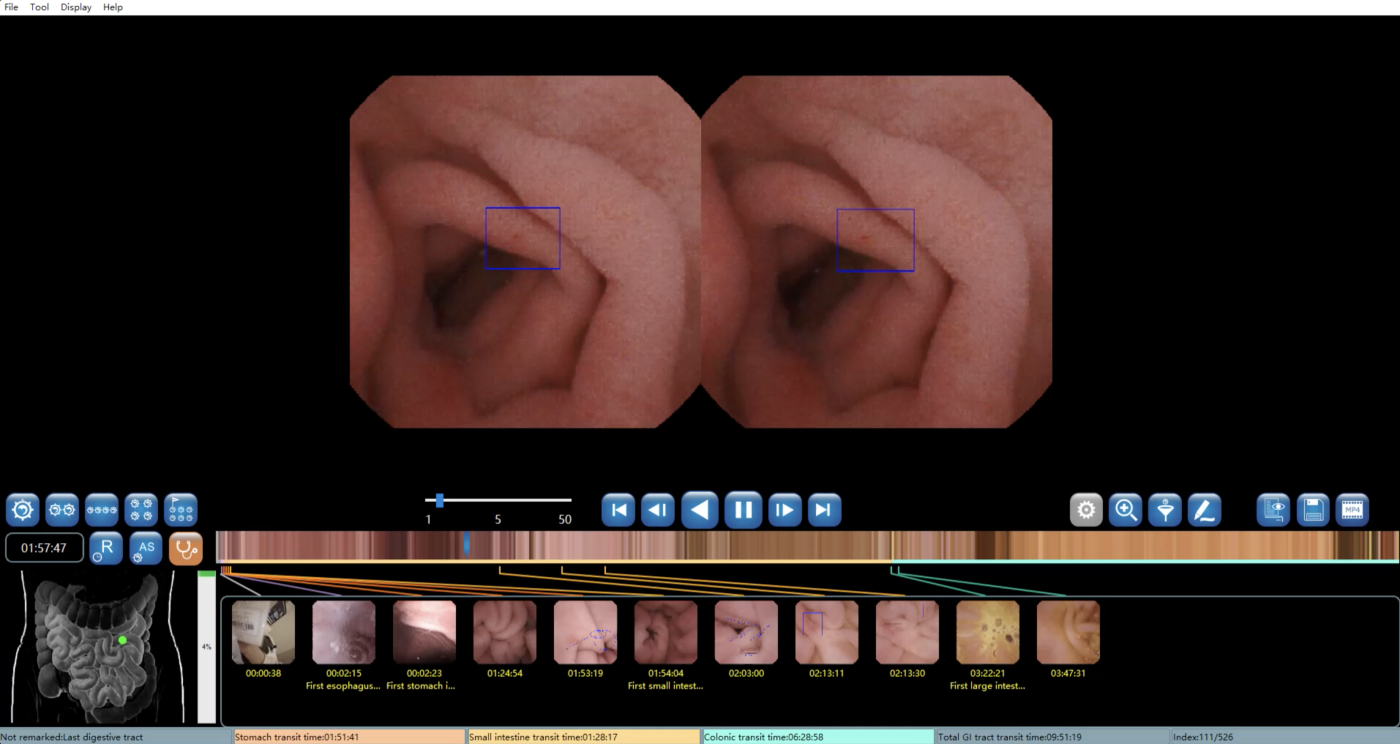 Small Bowel Capsule Endoscopy