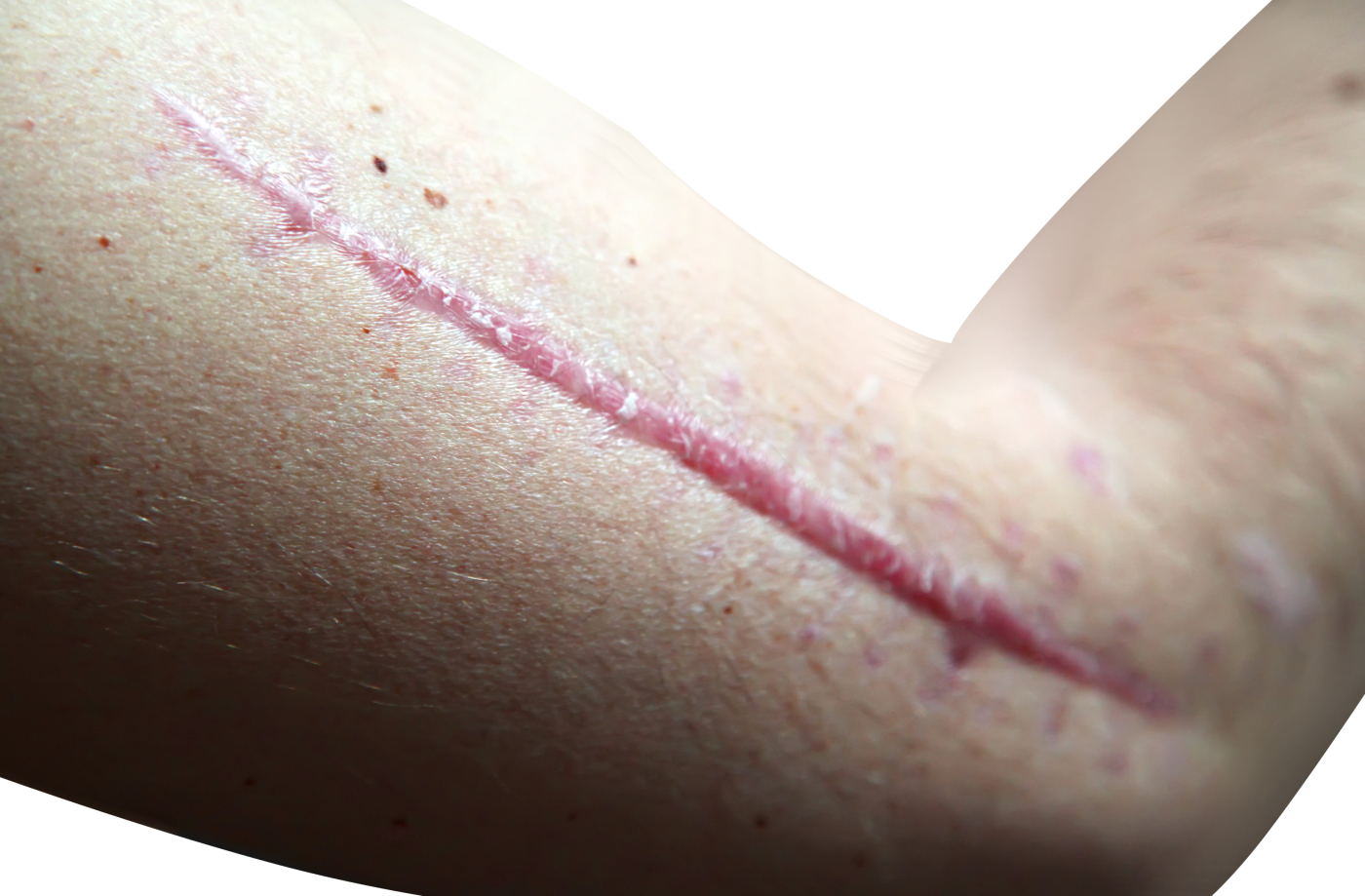 Scar