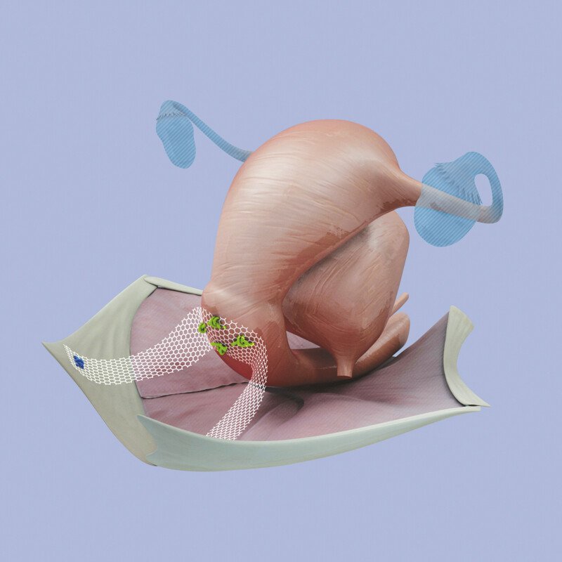 BSC Mesh
