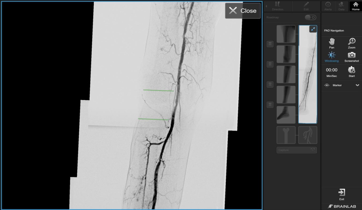 Vascular Navigation PAD 2