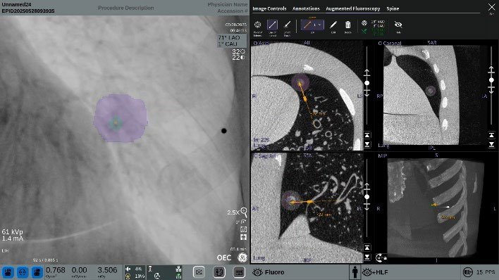 OEC 3D Lung Suite V5