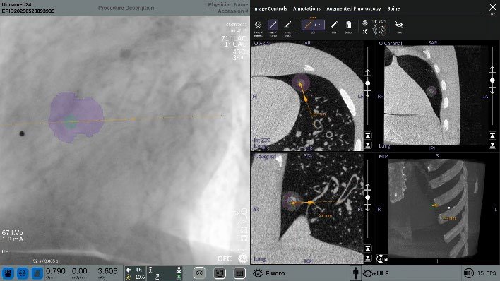 OEC 3D Lung Suite V4