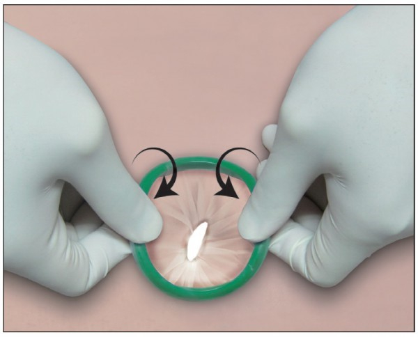 Lagis LapShield™ Wound Retractor