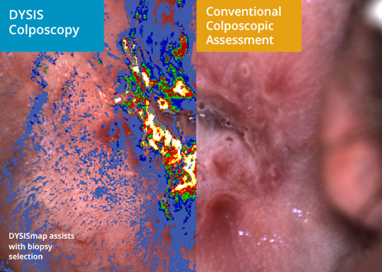 Dysis Smart Colposcopy