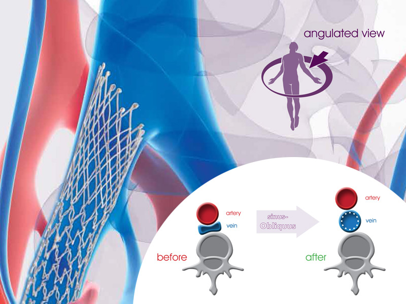 sinus-Obliquus