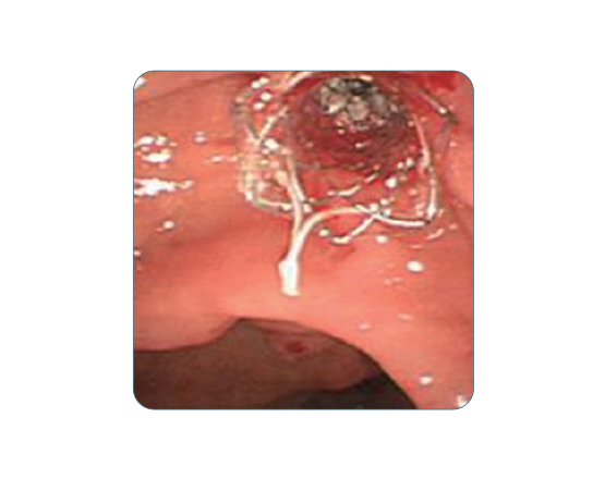 Niti-S™ BUMPY™ Biliary Stent - TaeWoong 4