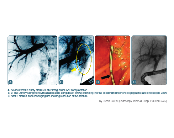 Niti-S™ BUMPY™ String Biliary Stent - TaeWoong 3