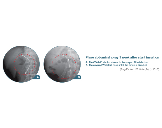 Niti-S™ COMVI Biliary Stent - TaeWoong 4