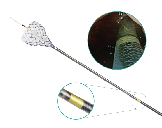 Niti-S™ Esophageal Covered Stent (Covered) - TaeWoong 3