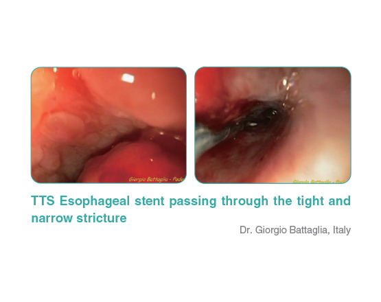 Niti-S™ Esophageal Covered Stent (Covered) - TaeWoong 4