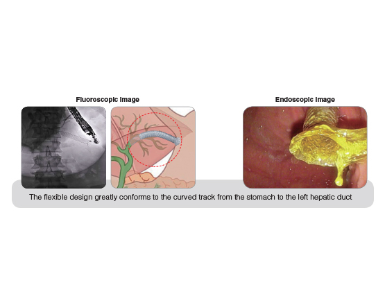 Niti-S™ GIOBOR™ Biliary Stent - TaeWoong 5