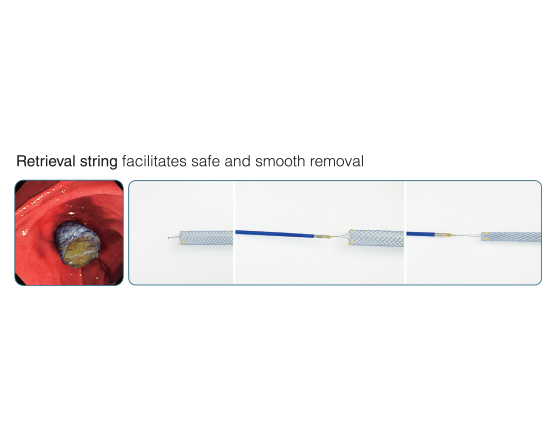 Niti-S™ S Biliary Stent (Covered) - Taewoong 4