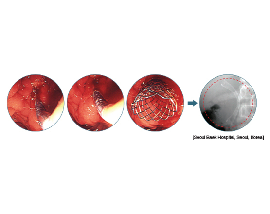 Niti-S™ S Biliary Stent (Uncovered) - Taewoong 4