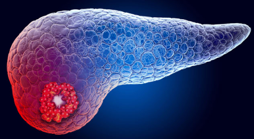 20-DDI-1892011-CQD-Pancreatic-Cysts