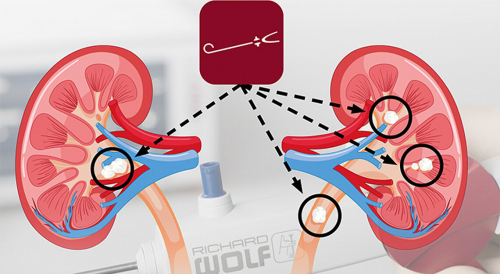 eMasterclass Workshop «Steintherapie – URS und Laserlithotripsie»